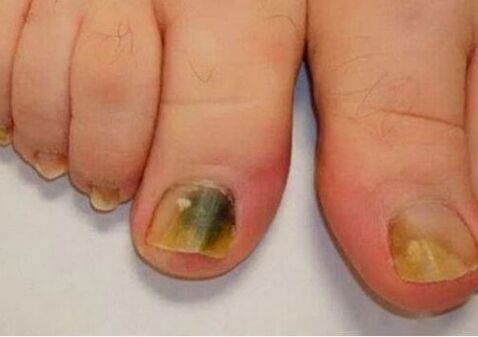 A infecção afeta as placas de unhas