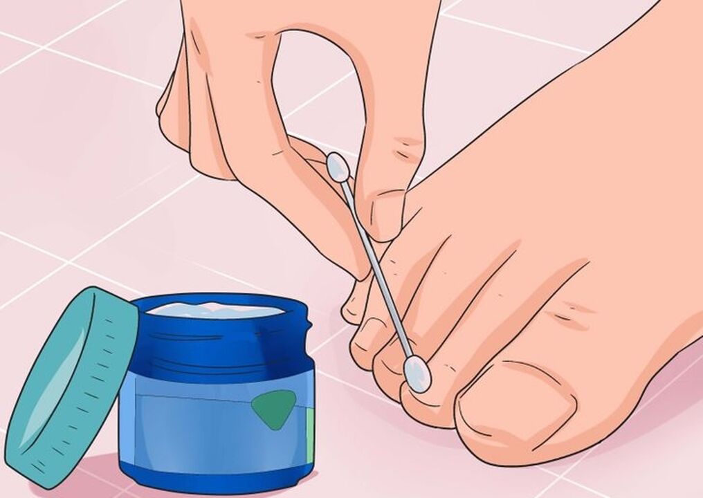 Cure o fungo das unhas