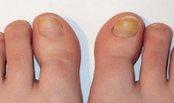 O estágio inicial do fungo das unhas