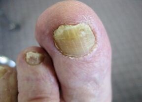 As causas da aparência do fungo nas unhas