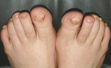 Sinais de fungo nas unhas