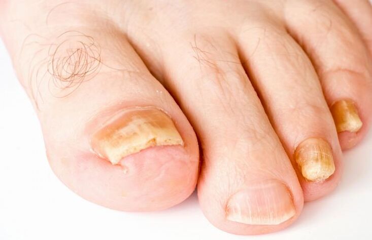 unhas amarelas devido a fungos
