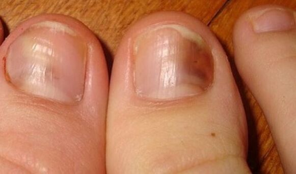 unhas afetadas por fungos
