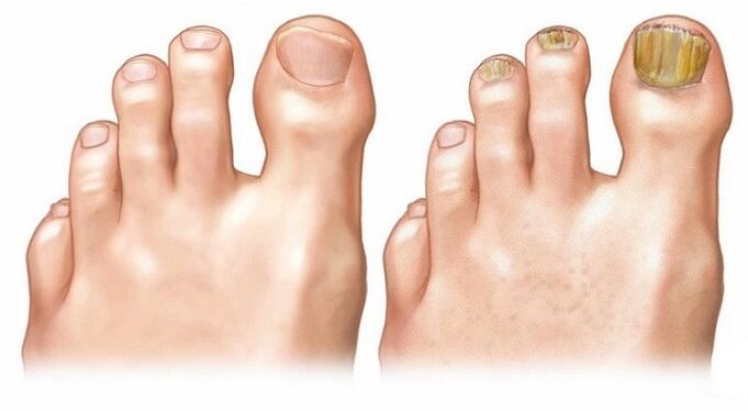 unhas saudáveis ​​e fungos nas unhas
