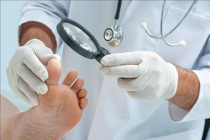 Antes de prescrever o tratamento para fungos nas unhas dos pés, o médico fará um exame