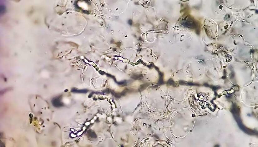 Fungos sob um microscópio – os culpados no desenvolvimento de micose nos pés